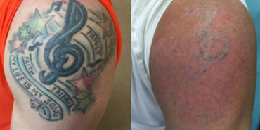 Laser Tattoo Removal - Prices, Results, Benefits, Risks - Nexus Clinic ,  Kuala Lumpur, Malaysia