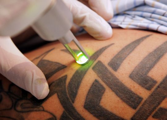 14 Aug 2009, Wiesbaden, Hesse, GERMANY:DEU --- The effects of a strong laser device on a tatoo, Wiesbaden, Germany, 14 August 2009. Meanwhile these laser devices usually allow scar-free and kind-to-the-skin removal of tattoos. Altering social standards and tastes may at times collide with once fashionable types of body art, demanding removal or other kinds of modification of the latter. Photo: Fredrik von Erichsen --- Image by © A3778 Fredrik von Erichsen/dpa/Corbis