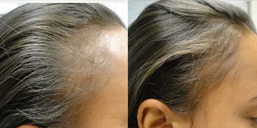 How Does PRP Work for Hair Loss? Before & After Treatment Results