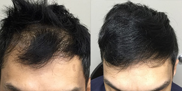 PRP for Hair Loss Treatment - Info, Price, Reviews -Nexus Clinic