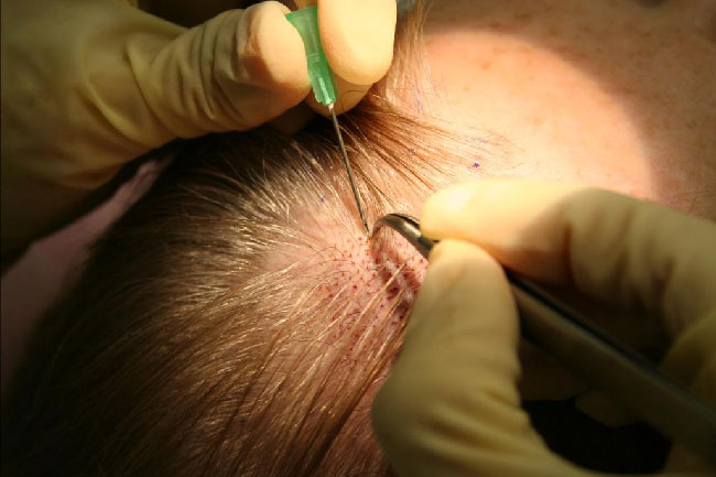 Hair Transplant in Malaysia - Cost and Reviews- Nexus Clinic