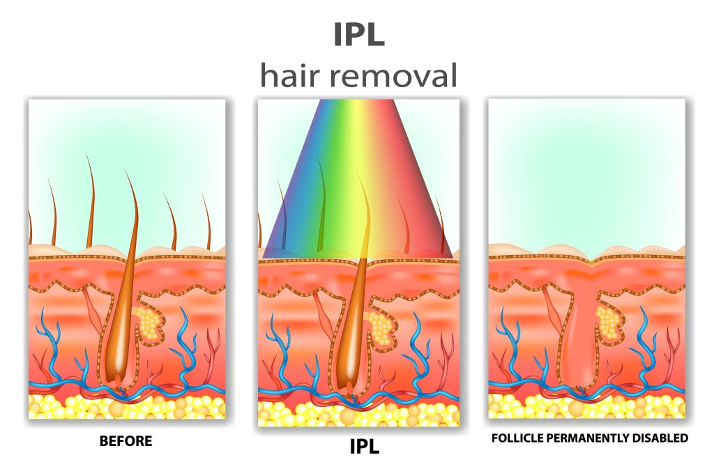 ipl-hair-removal