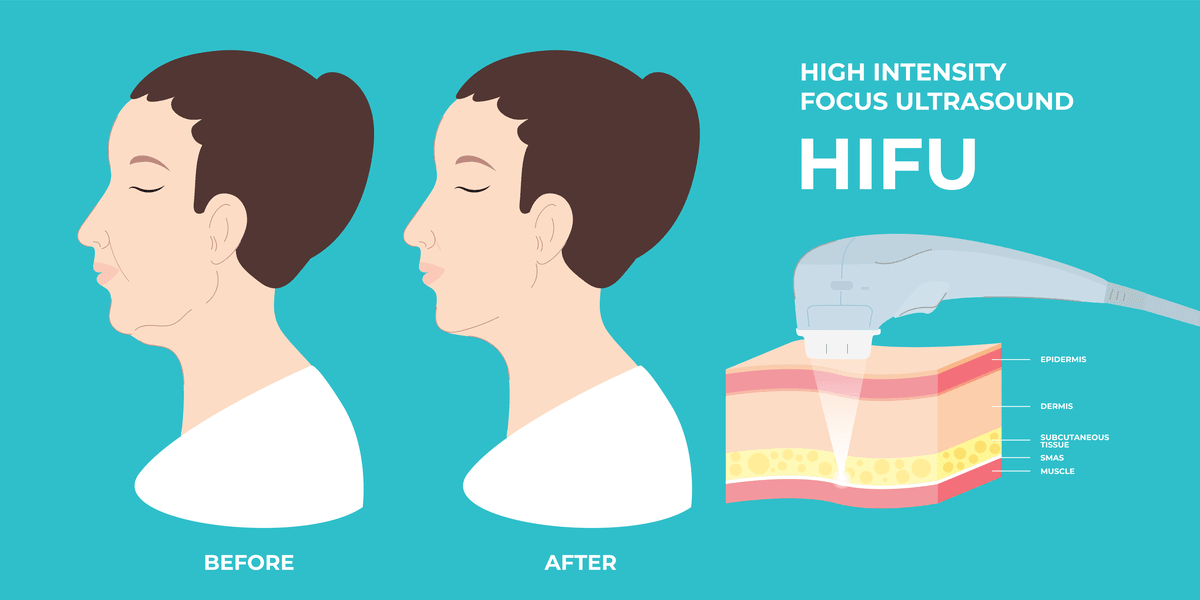 HIFU-Treatment-Face-Before-And-After