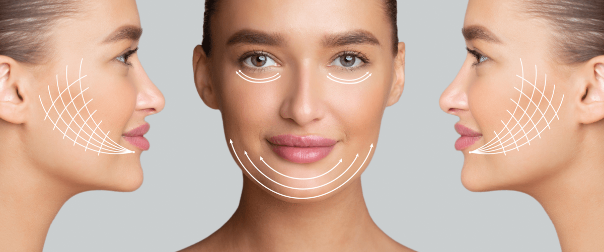 threadlift-lines-in-face